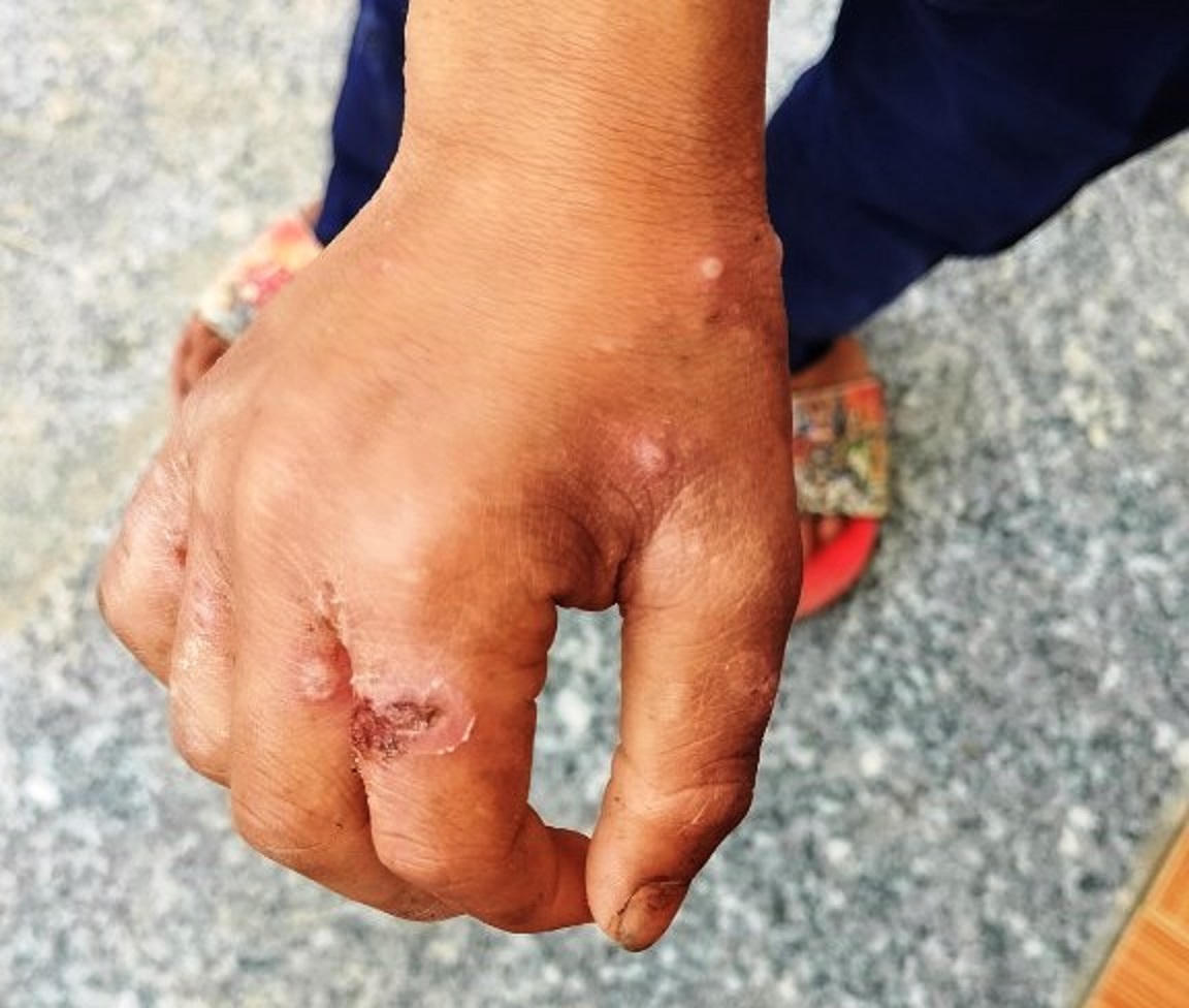 Hàng trăm người mắc bệnh ghẻ ở thôn vùng cao tỉnh Quảng Ngãi