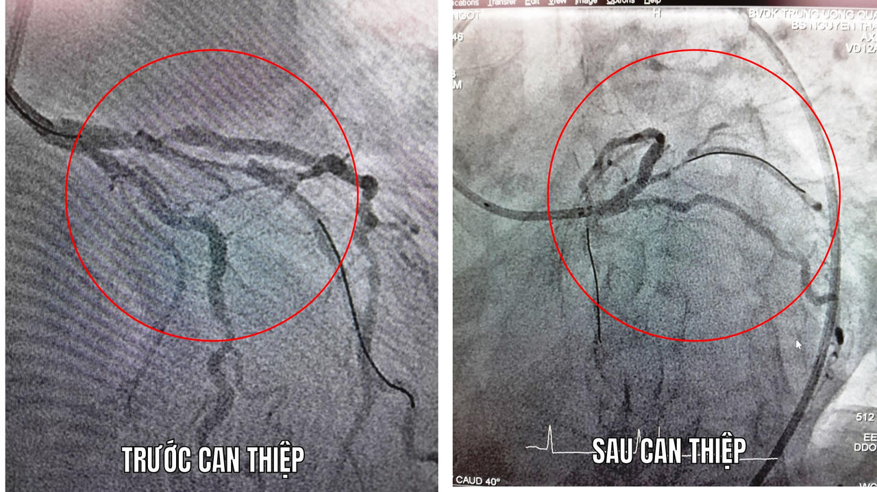 Cụ bà 77 tuổi ngừng tim được cứu sống