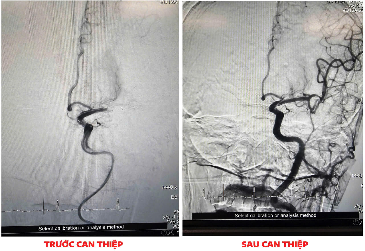 Can thiệp lấy huyết khối qua đường động mạch cứu người phụ nữ đột quỵ não