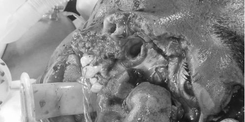 Huế: Cứu sống bệnh nhân mặt bị dập nát toàn bộ 