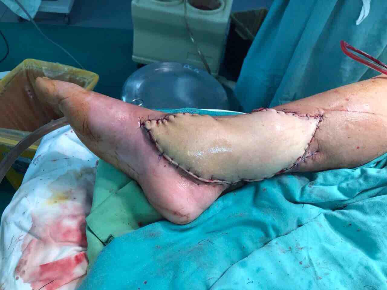 Người phụ nữ bị rắn độc cắn, phải phẫu thuật chỉnh hình