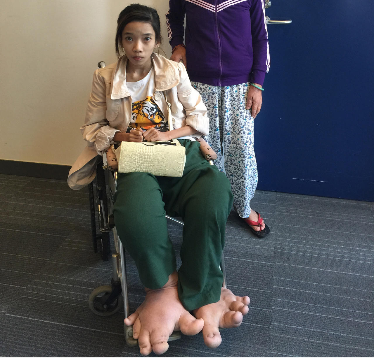 Cô gái có đôi chân “voi” đã được phẫu thuật