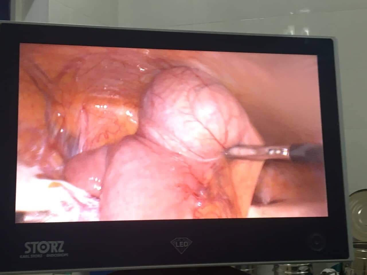 Nghi vấn bệnh nhân “chết oan” do bị bác sĩ chẩn đoán nhầm u ác là u lành