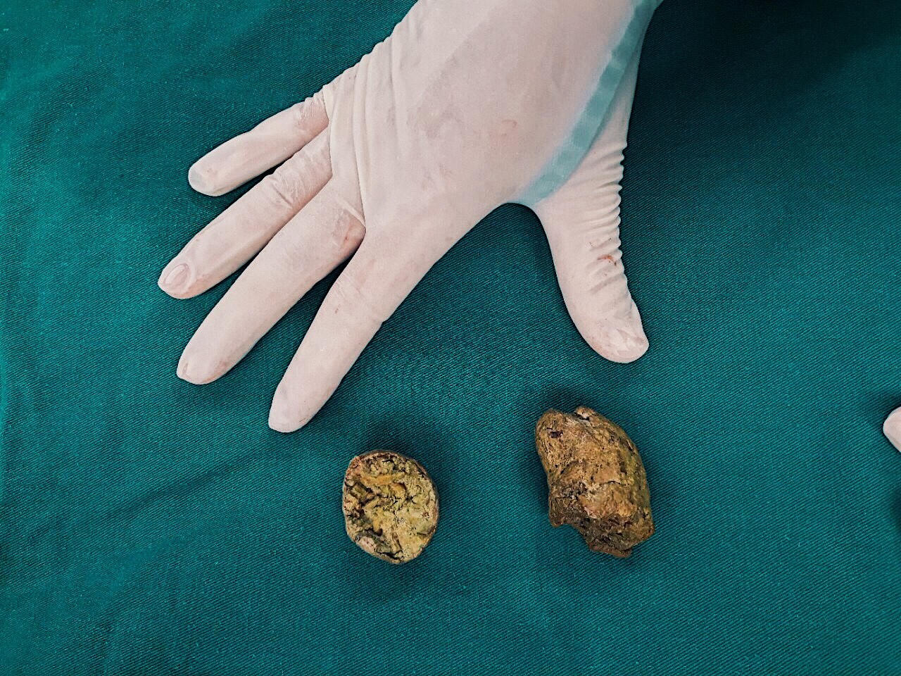 BVĐK tỉnh Phú Thọ cứu sống bé gái bị tắc ruột vì ăn quá nhiều hồng ngâm, sung