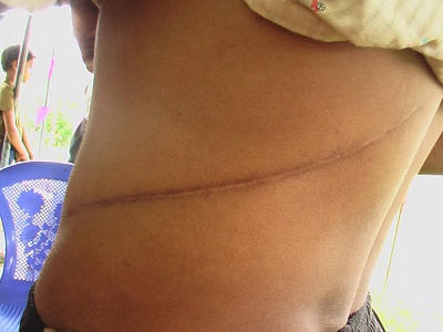 Kỳ lạ ngôi làng nhiều người dân “chỉ có” một quả thận