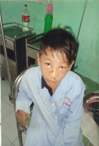 Thái Bình: Một thiếu niên bị rách mũi sau khi làm việc với công an