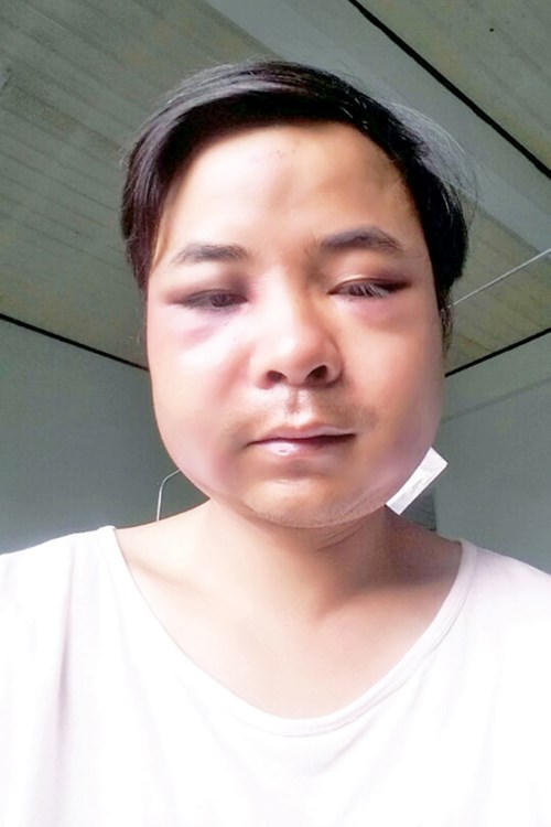 Cán bộ kiểm lâm bị giật súng, đánh sưng mặt và quỳ gối (*)