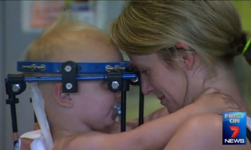 "Thần kỳ" ca mổ nối đầu cổ bé trai bị tai nạn giao thông