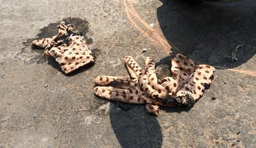 Nữ sinh viên nghi bị tạt axit giữa phố Sài Gòn