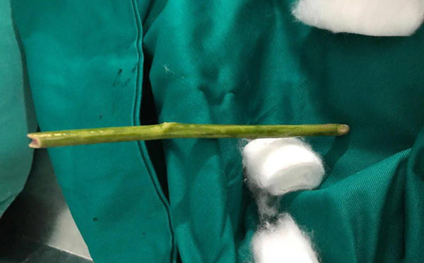 phá thai, Tuyên Quang