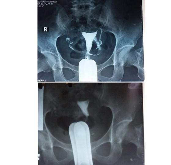 Thành tựu đáng tự hào của ngành y tế năm 2017