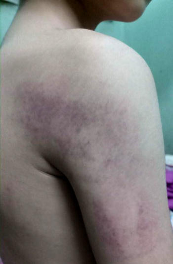 Bả vai và cánh tay học sinh Tùng (lớp 1, tiểu học Kiêu Kỵ, Hà Nội) bị tím bầm vì giáo viên đánh. Ảnh: Gia đình cung cấp.