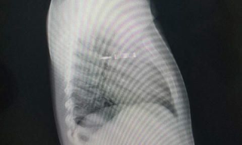 Bé gái 4 tuổi bị bút bi đâm thấu ngực