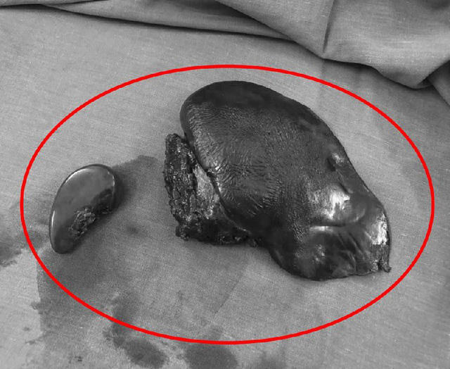 Gan trái của bệnh nhân bị đứt gần lìa sau tai nạn, buộc phải cắt bỏ 