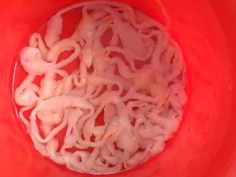 Rùng mình: Sán xơ mít dài 9m trong bụng nam thanh niên