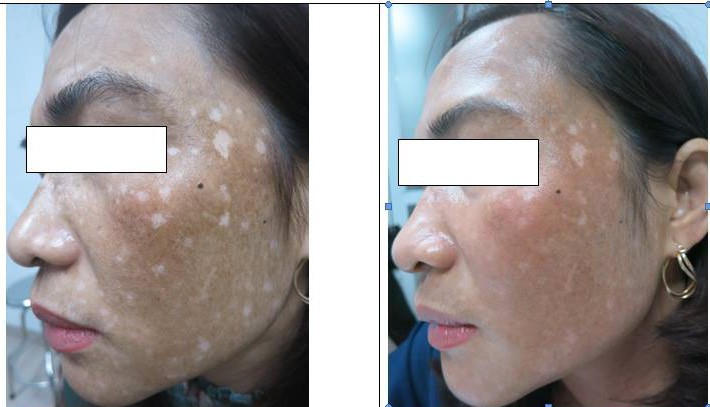 Hoảng hồn gương mặt lốm đốm nốt trắng, nốt đen vì đắp lá trầu làm đẹp - Ảnh 1.