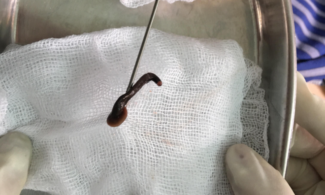 Con đỉa được gắp ra khỏi họng bệnh nhân. Ảnh: Bệnh viện cung cấp.
