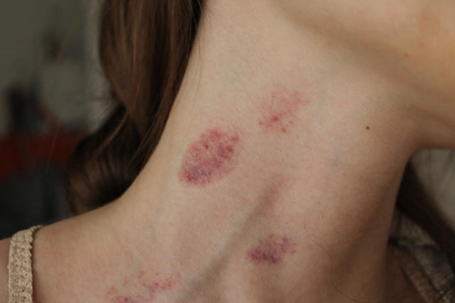 Cô gái 16 tuổi tử vong vì vết hôn cổ của bạn trai