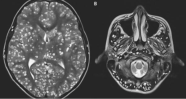 Ăn thịt lợn chưa nấu chín, nam thanh niên chết do sán làm tổ dày đặc trong não