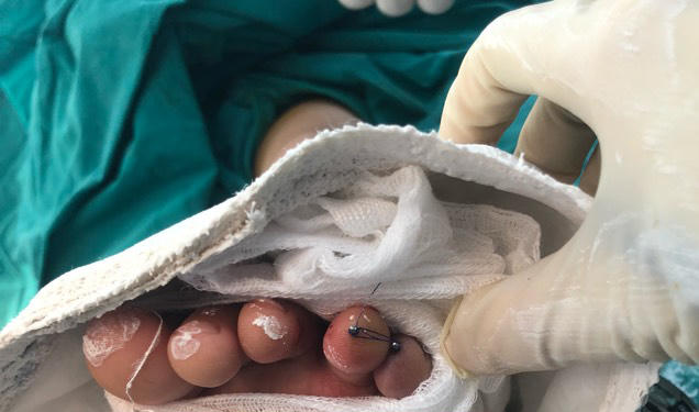 Bé trai 6 tuổi bị 'tấm ốp sành điệu' xe Air Blade cắt đứt 2 ngón chân 