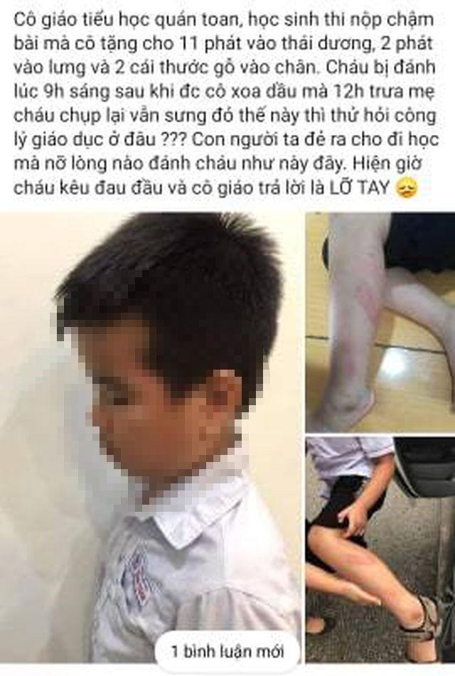 Đánh nam sinh lớp 2 sưng tấy, bầm tím chân, cô giáo bị tạm đình chỉ công tác
