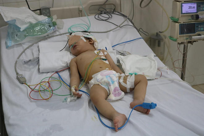 Tivi 34 inch rơi trúng đầu, bé 13 tháng dập não hôn mê