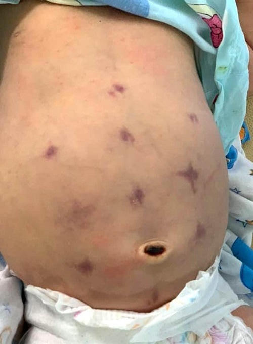 Trẻ sơ sinh bầm tím khắp người vì người lớn thay nhau cấu véo chữa đầy hơi