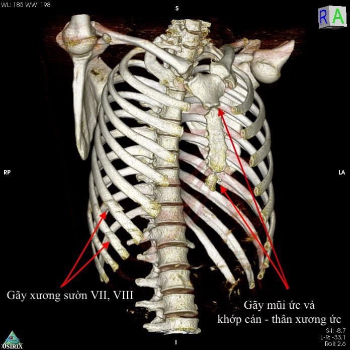 Ngủ gật khi đi xe máy, nam thanh niên Hà Nội bị thủng tim và vỡ gan