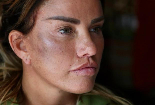 Người mẫu 'bốc lửa' Katie Price bị trộm đánh thâm tím mặt