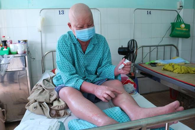 Stress vì mất việc mùa dịch, nhiều người ở TP HCM bỗng 'mọc vảy' khắp cơ thể