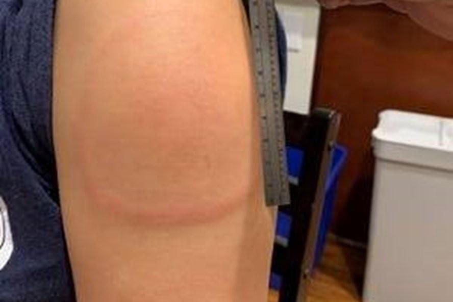 Phản ứng sau tiêm vaccine COVID-19, làm sao để giảm rủi ro?