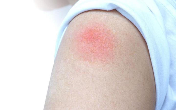 Xuất hiện hiện tượng 'cánh tay COVID' sau tiêm vaccine ở trẻ, cha mẹ xử trí thế nào?