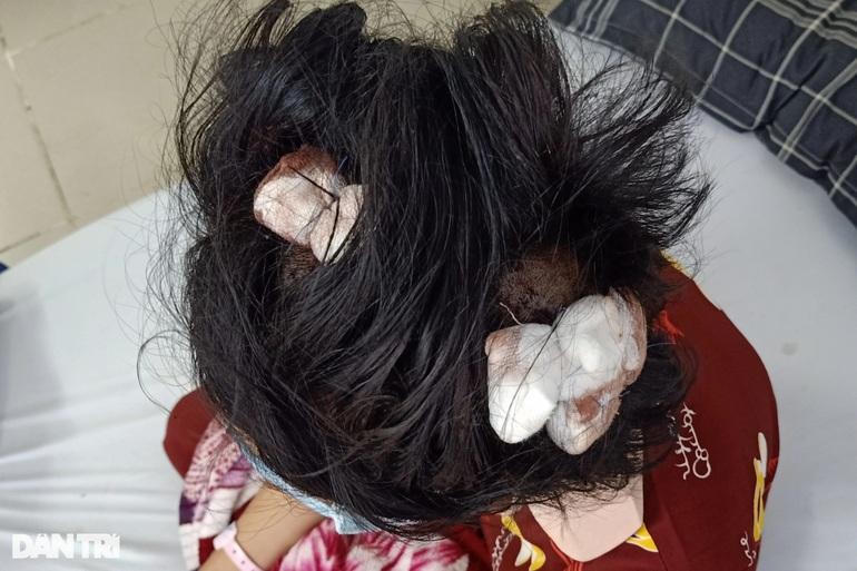 Bé gái 16 tuổi bị người tình của mẹ vụt gậy sắt đến bất tỉnh