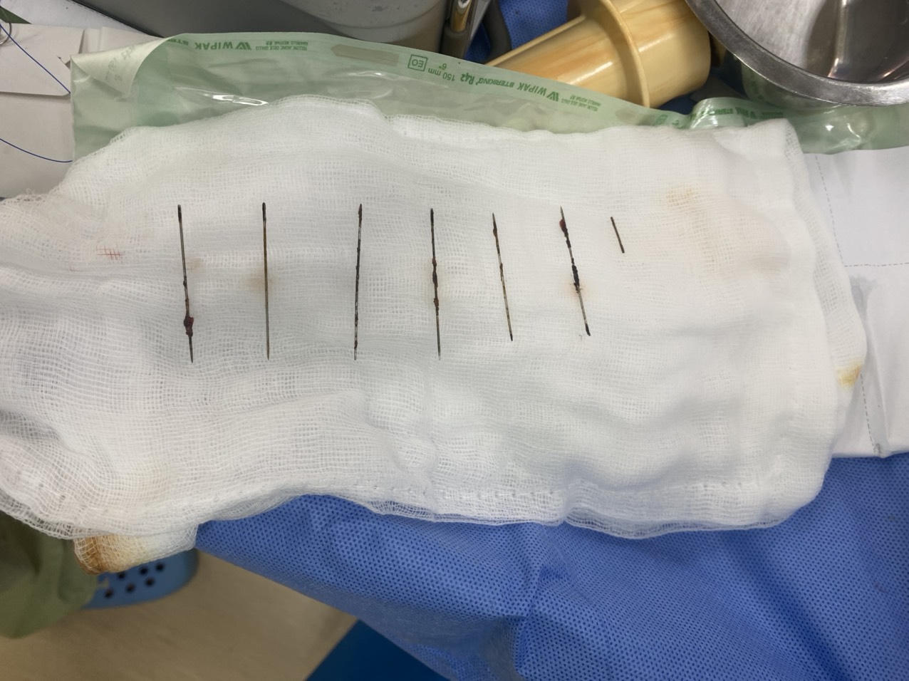 Bị stress tự lấy 7 cây kim đâm vào ngực - Ảnh 1.