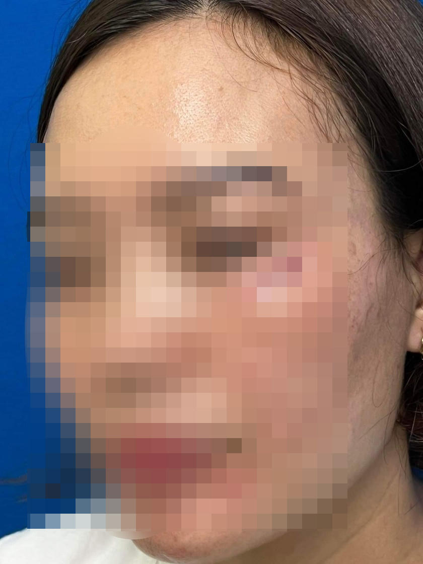 Phồng hàm, xệ mắt, nguy cơ biến chứng kéo dài vì tiêm Botox 'chỗ người quen'