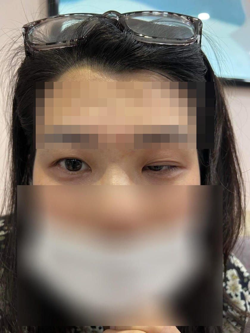 Phồng hàm, xệ mắt, nguy cơ biến chứng kéo dài vì tiêm Botox 'chỗ người quen'