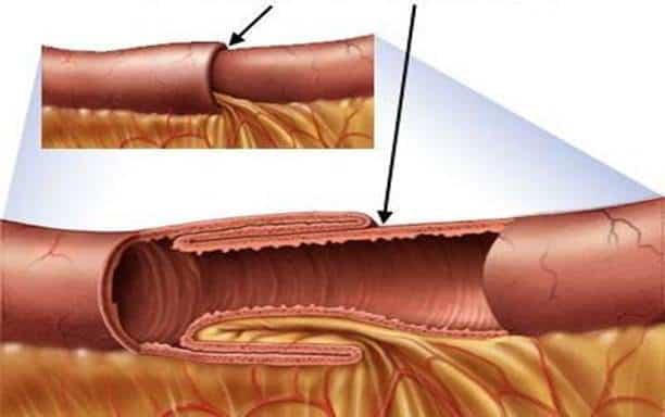 Nhận biết và điều trị kịp thời lồng ruột ở người lớn