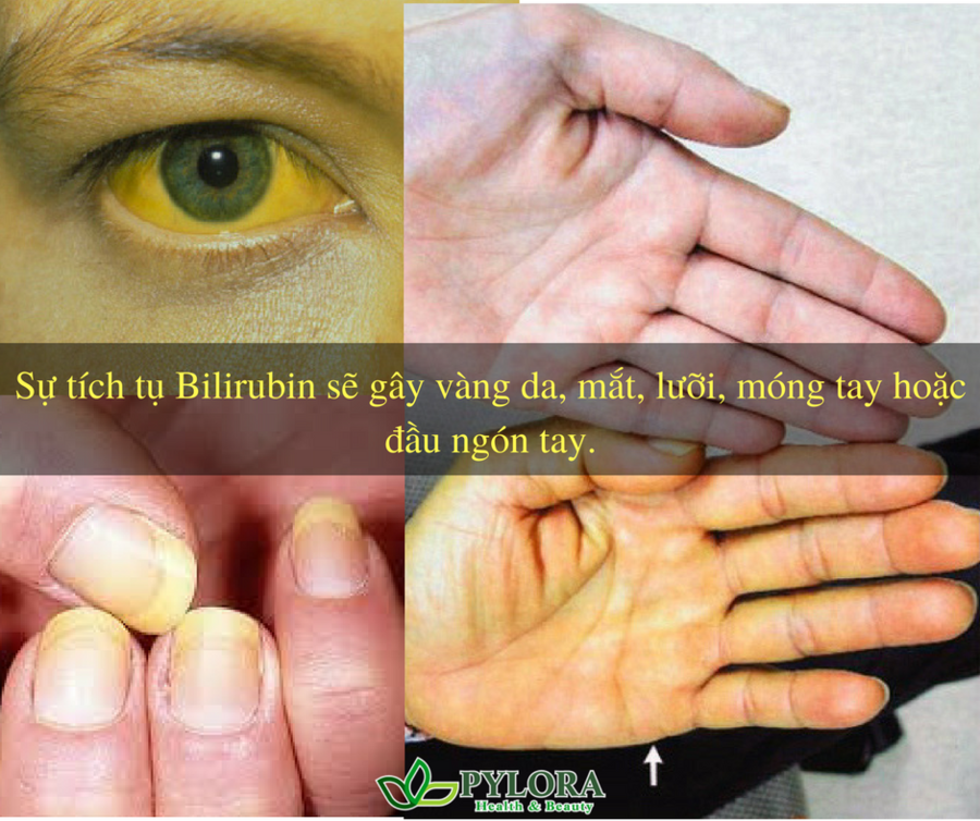 Vàng da ở người lớn là bệnh gì?