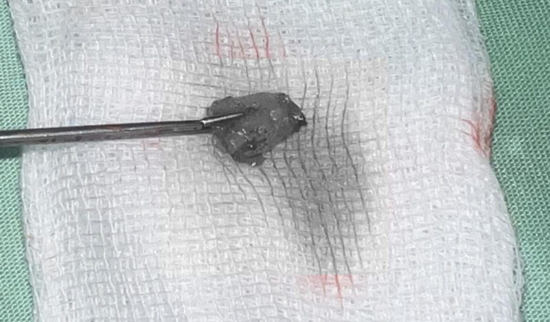 BV Trung ương Huế ứng dụng kỹ thuật cao lấy dị vật bịt lỗ thông xoang hàm