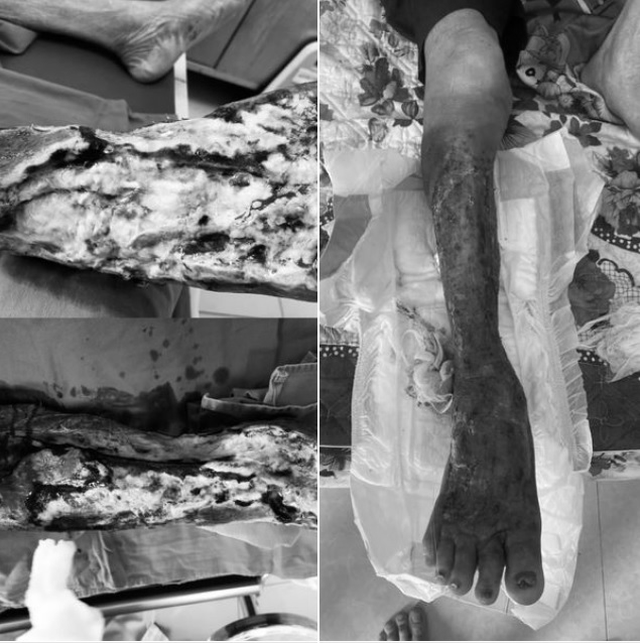 Loại vi khuẩn cực độc 'ăn mòn' cẳng chân người đàn ông