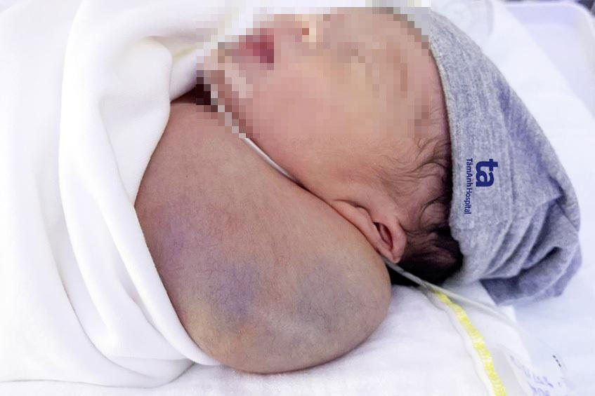 BVĐK Tâm Anh cứu sống bé sơ sinh có khối u nặng bằng 1/3 trọng lượng cơ thể