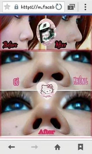 Cảnh giác với 'mũi Silicon Hàn Quốc' không cần phẫu thuật