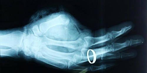 Nghệ An: Nối thành công ngón tay cái bị đứt lìa cho một bệnh nhân