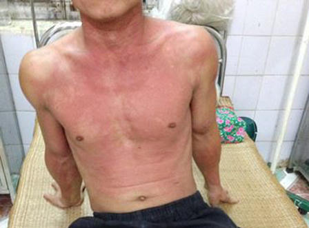 Chặt cây trong vườn bị kiến lạ cắn nguy kịch