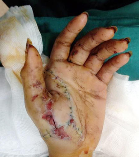 Bé trai 12 tuổi nghịch pháo nát hai tay, có thể bị mù