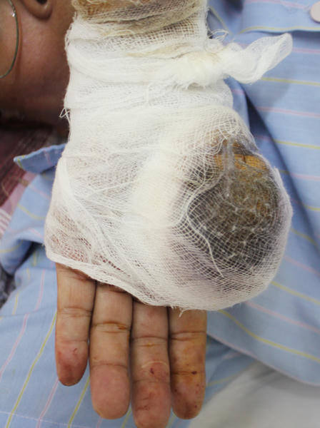 Truy bắt nhóm thanh niên chém cụ ông 70 tuổi đứt lìa ngón tay