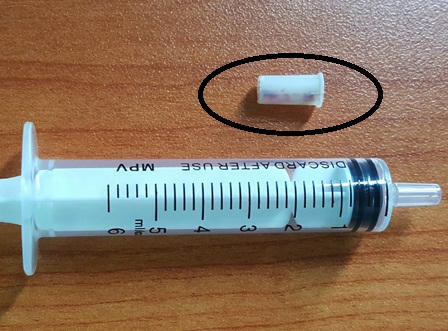 Gắp chiếc kèn nhựa trong cổ họng cháu bé 6 tuổi 