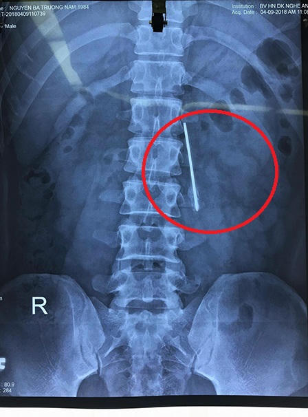 Gắp con dao dài 13cm nằm trong cơ thể chiến sĩ công an 11 năm