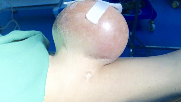 Cắt khối u nặng 2kg dính suốt 12 năm trên người đàn ông