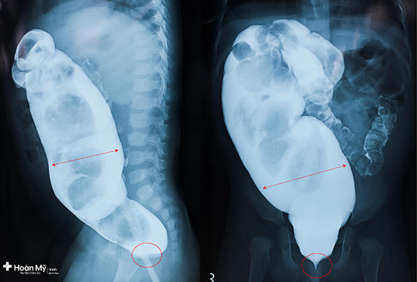 Dấu hiệu hẹp hậu môn ở trẻ nhỏ